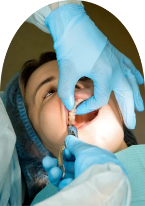 A beyondental dentist is extracting the patient's wisdom tooth